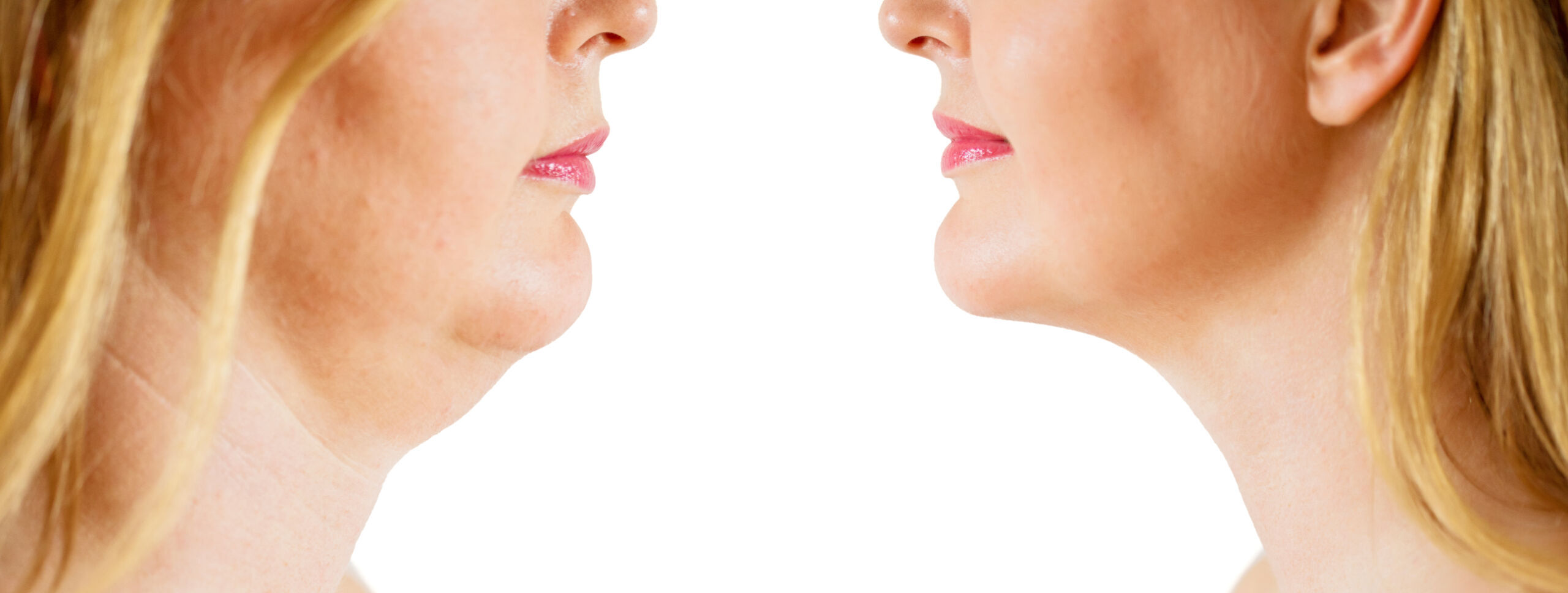 fixing a Double Chin before and after